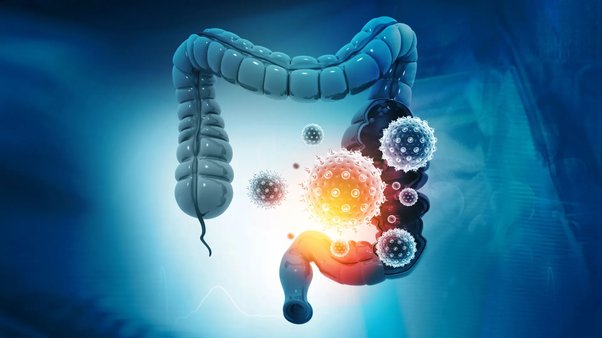 Scientists finally discover how a common gut bacterium can trigger colon cancer